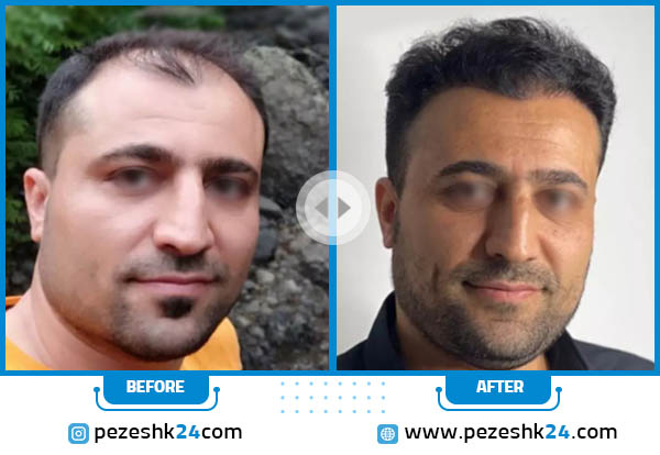 قبل و بعد کاشت مو در کلینیک شارمین