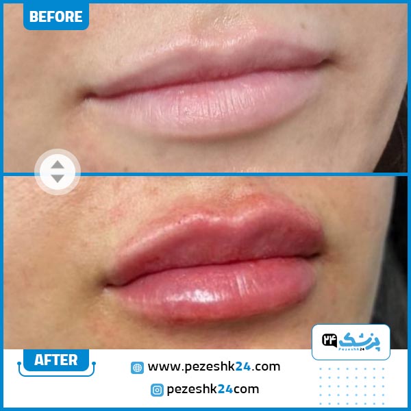 تزریق ژل لب در کلینیک اوینا