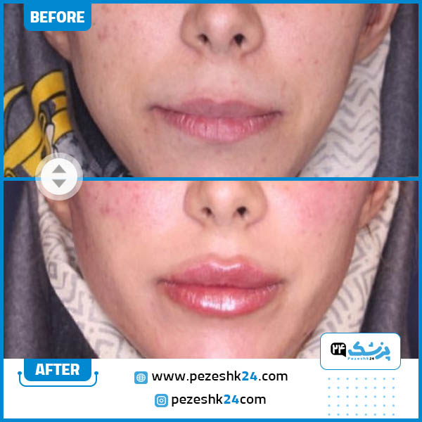 قبل و بعد تزریق ژل لب درکلینیک ایرانیان