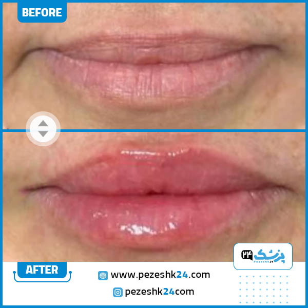 تزریق ژل لب در کلینیک پارادایس