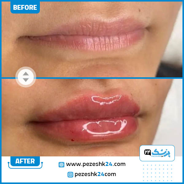 قبل و بعد تزریق فیلر لب در کلینیک شایلین