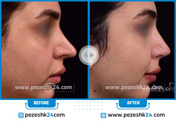 نمونه عمل جراحی ترمیمی بینی