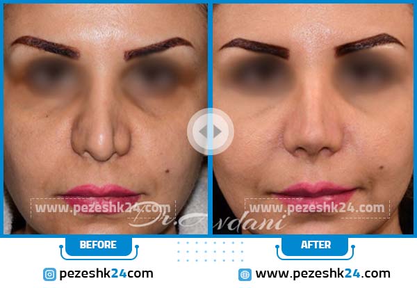 نمونه عمل ترمیمی بینی در مشهد