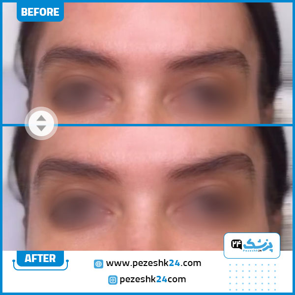 قبل و بعد تزریق فیلر لیفت شقیقه در کلینیک پارادایس