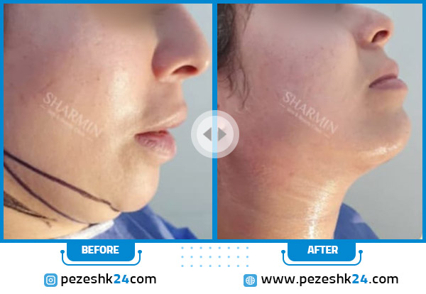 ساکشن غبغب در کلینیک شارمین