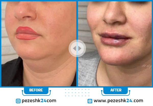 قبل و بعد رفع غبغب در کلینیک شایلین