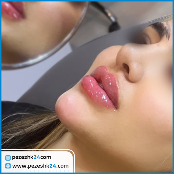 فیلر چانه در کلینیک هیلدا