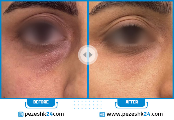 رفع گودی وتیرگی زیرچشم در کلینیک هیلدا