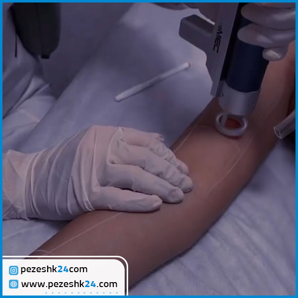 لیزر موهای زائد دست در کلینیک شایلین