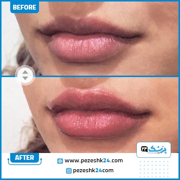 قبل و بعد تزریق ژل لب در کلینیک اکسیر