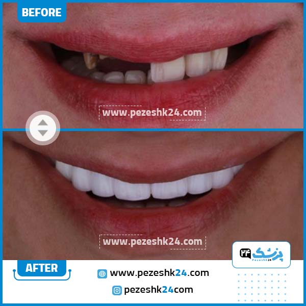 قبل و بعد ایمپلنت دندان کلینیک روشا