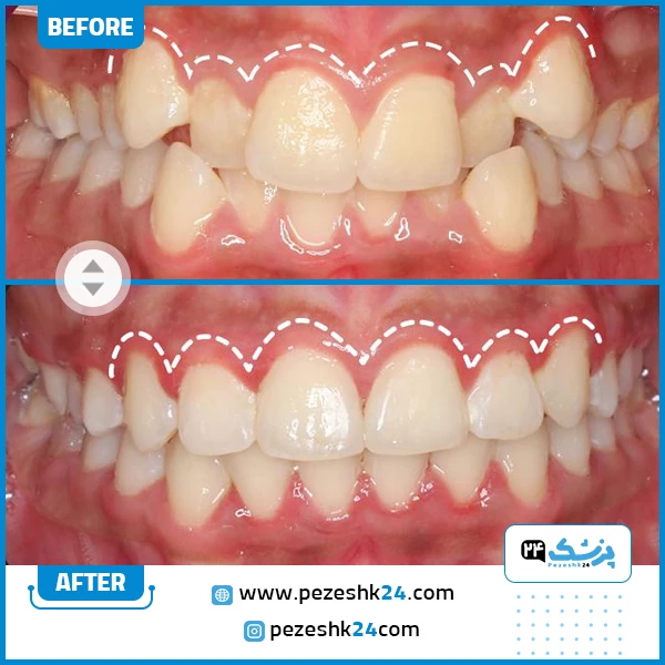 قبل و بعد ارتودنسی دندان دکتر نخعی