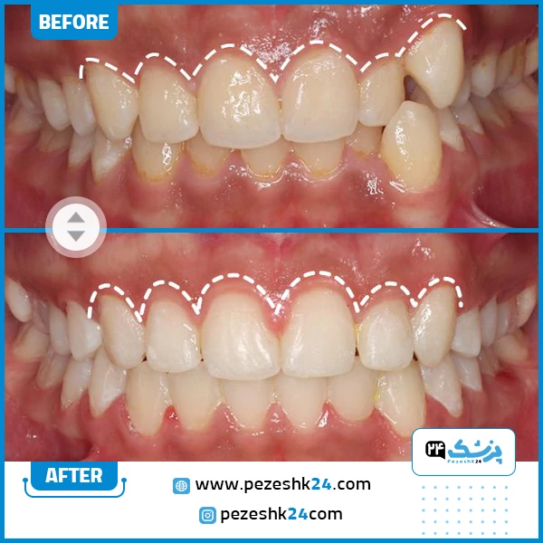 قبل و بعد ارتودنسی دندان دکتر نخعی مشهد