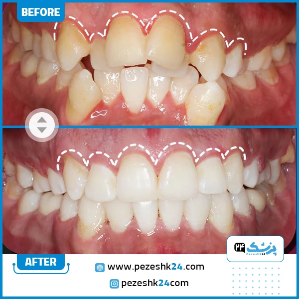 قبل و بعد ارتودنسی دکتر نخعی مشهد