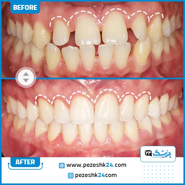 قبل و بعد ارتودنسی دکتر نخعی