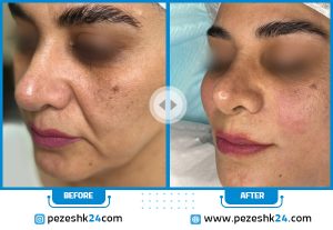 قبل و بعد هایفوتراپی صورت در مشهد دکتر کاشانی