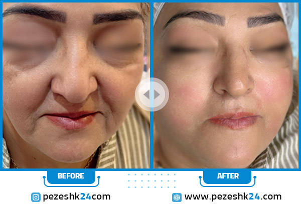 قبل و بعد هایفوتراپی صورت مشهد دکتر کاشانی