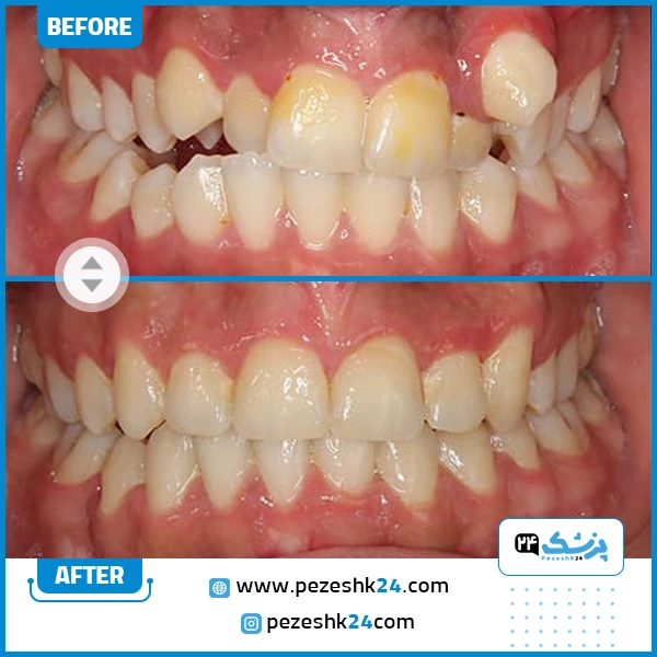 نمونه ارتودنسی دندان دکتر محولاتی مشهد