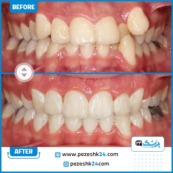 قبل و بعد ارتودنسی دندان دکتر محولاتی