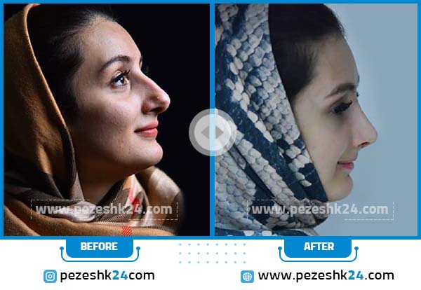 قبل و بعد عمل بینی نیمه فانتری دکتر سبزاری
