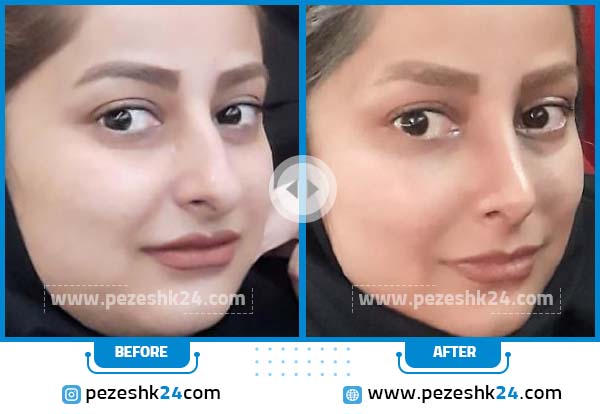 قبل و بعد عمل بینی نیمه فانتری در مشهد دکتر هماسبزاری