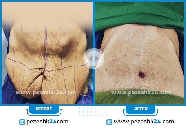 قبل و بعد پیکرتراشی تهران دکتر محمد ابطحی