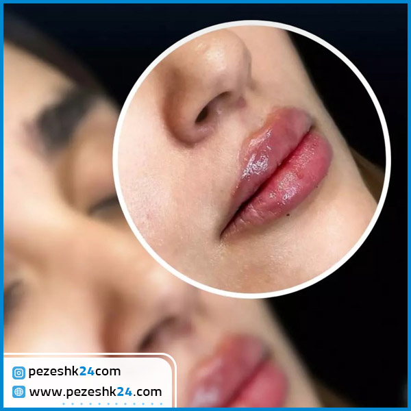 فیلر لب در کلینیک شارمین