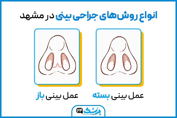 انواع روش جراحی بینی مردانه مشهد