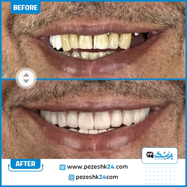 قبل و بعد ایمپلنت دندان دکتر عبداله زاده تهران