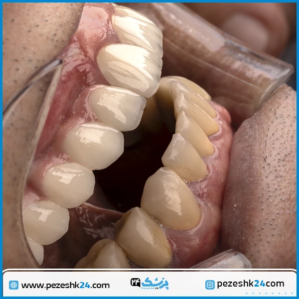 نمونه ایمپلنت دندان دکتر عبداله زاده تهران