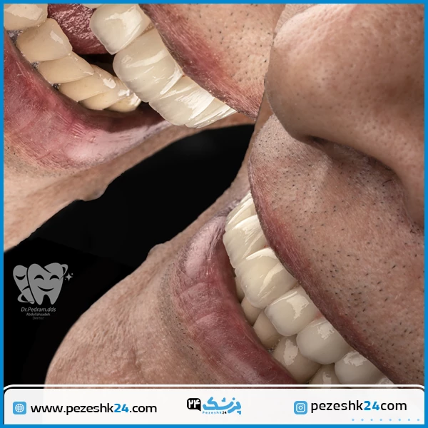 نمونه ایمپلنت دکتر عبداله زاده تهران