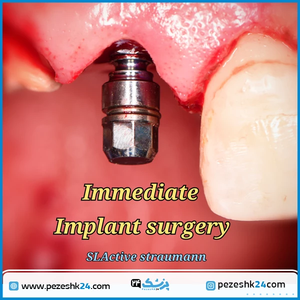 ایمپلنت دندان با دکتر مهدی کریمی