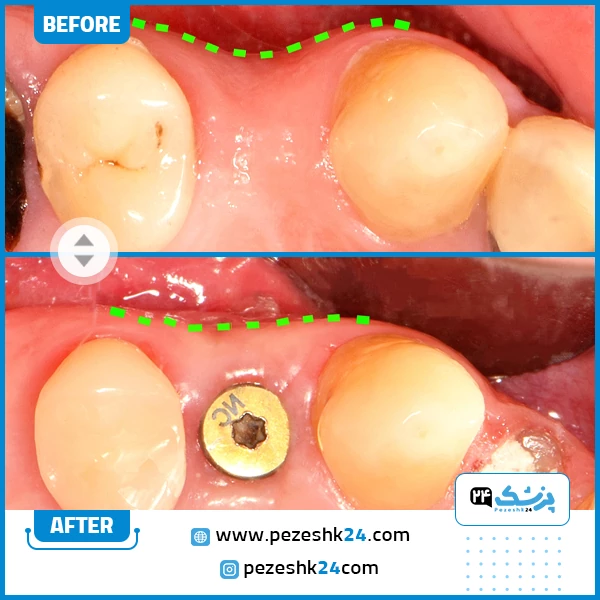قبل و بعد ایمپلنت دندان با دکتر مهدی کریمی
