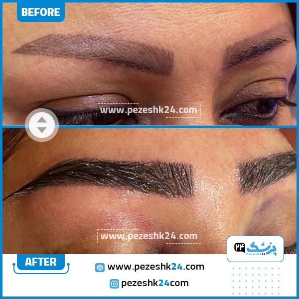 قبل و بعد کاشت ابرو کلینیک تندیس سلامت مشهد