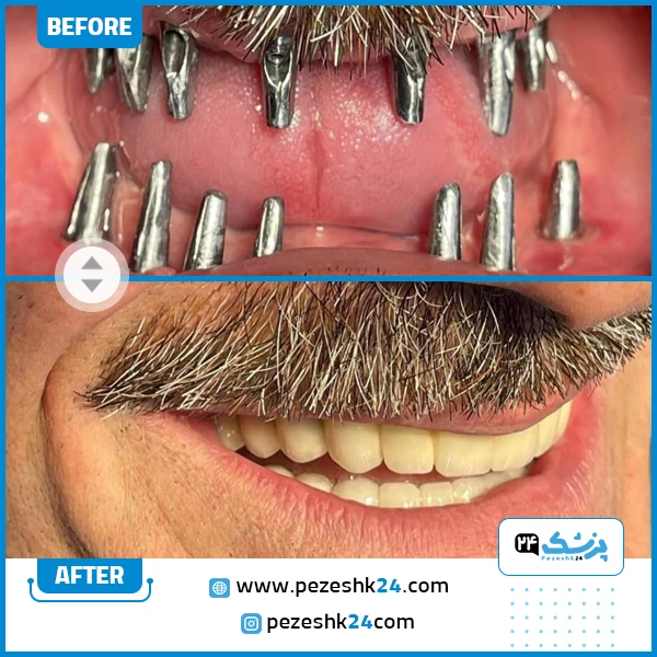 قبل و بعد ایمپلنت دکتر محمدی تهران