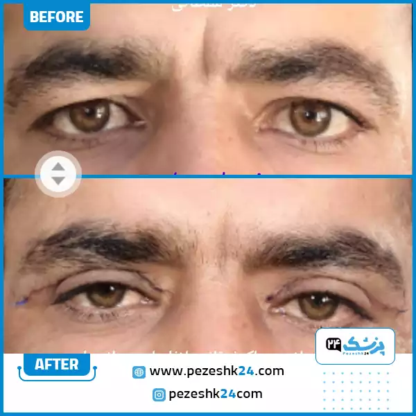 قبل و بعد زیبایی پلک دکتر سلطانی
