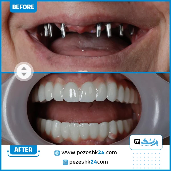 عکس ایمپلنت دندان فک بالا و پایین توسط دکتر سامان کلانتری در تهران