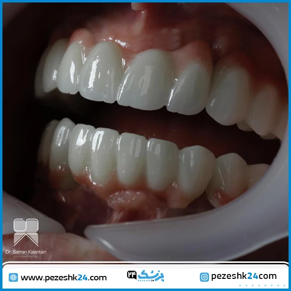 عکس ایمپلنت دندان دکتر سامان کلانتری در تهران