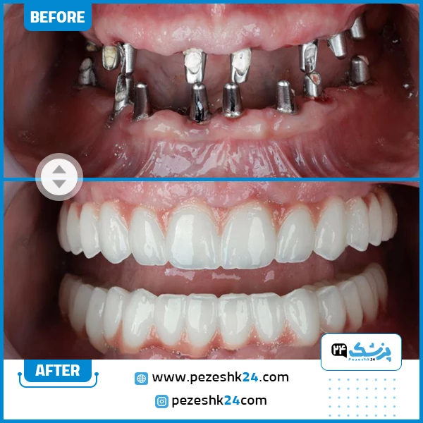 نمونه کار بهترین دکتر ایمپلنت دندان سامان کلانتری در تهران