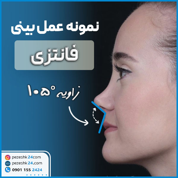 نمونه عمل بینی فانتزی