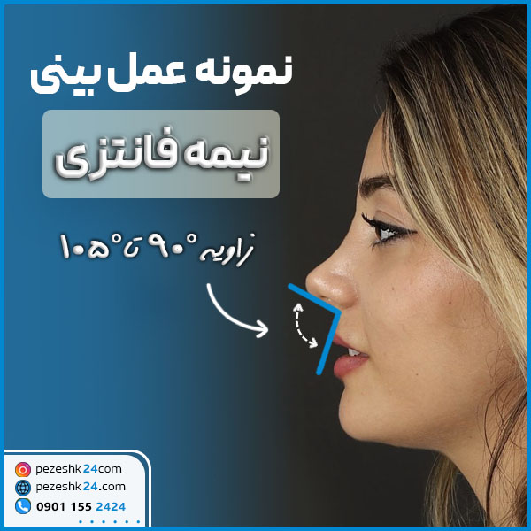 نمونه عمل بینی نیمه فانتزی