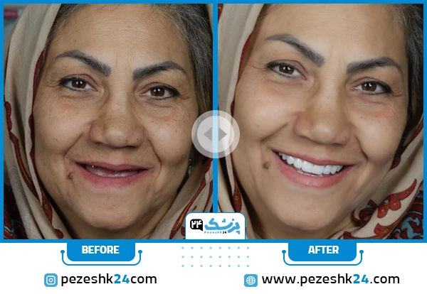 نمونه کار ایمپلنت دندان برای خانم ها توسط دکتر سامان کلانتری در تهران