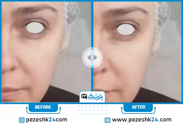 هایفو صورت در کلینیک سایه مشهد