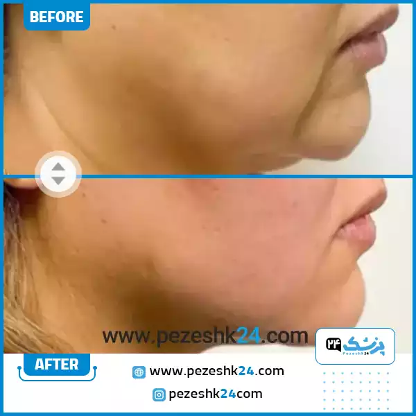 قبل و بعد هایفو غبغب در کلینیک سایه مشهد