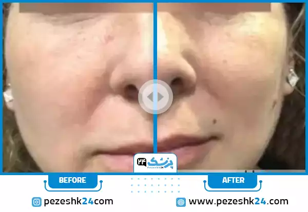 قبل و بعد هایفو صورت در کلینیک سایه مشهد
