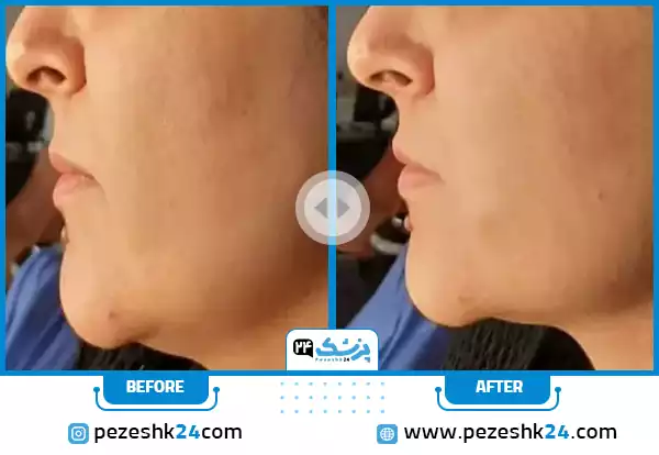 عکس قبل و بعد هایفوتراپی غبغب دکتر مدنی