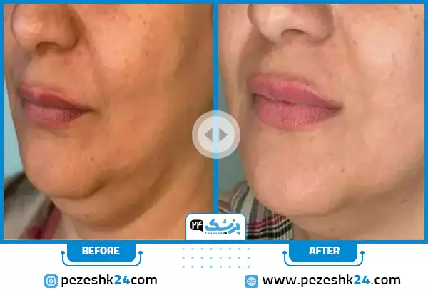 عکس قبل و بعد هایفوتراپی غبغب دکتر مدنی در مشهد