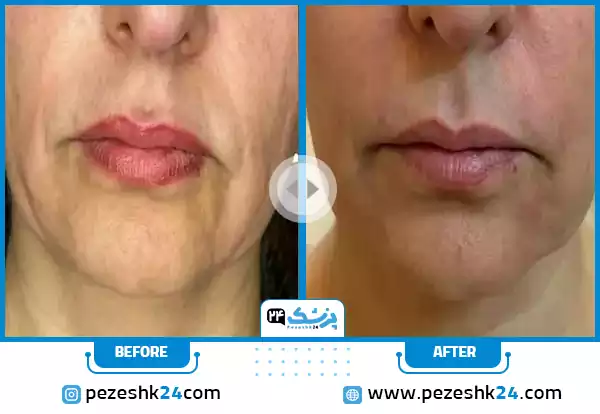 هایفو صورت از جلو توسط دکتر مدنی
