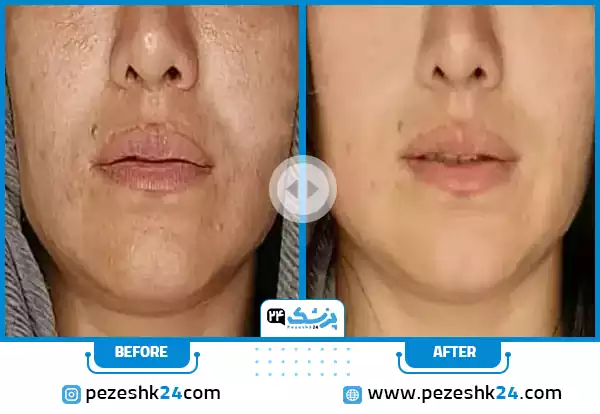هایفو خط لبخند توسط دکتر مدنی
