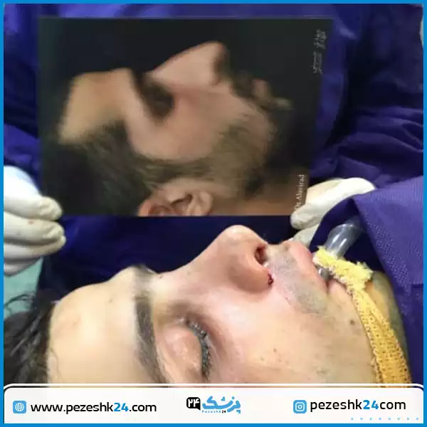 قبل و بعد عمل بینی فانتزی دکتر علوی راد